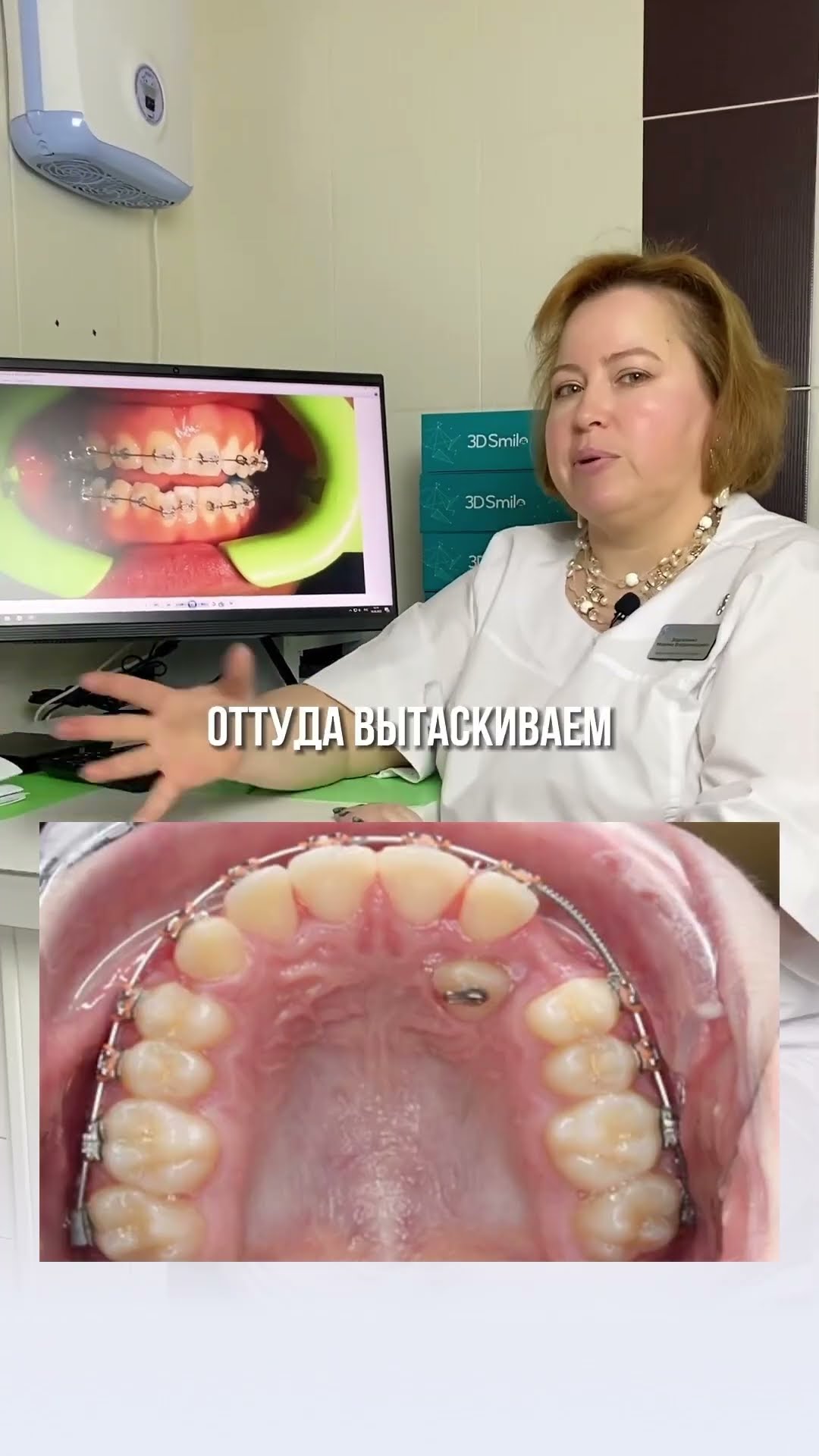 превью для видео: Зубы так и не вылезли (ретенированные зубы)