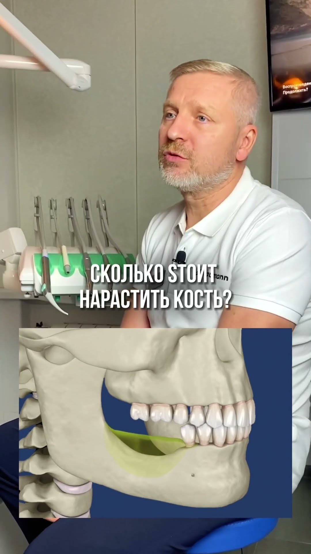 превью для видео: Сколько стоит нарастить кость?