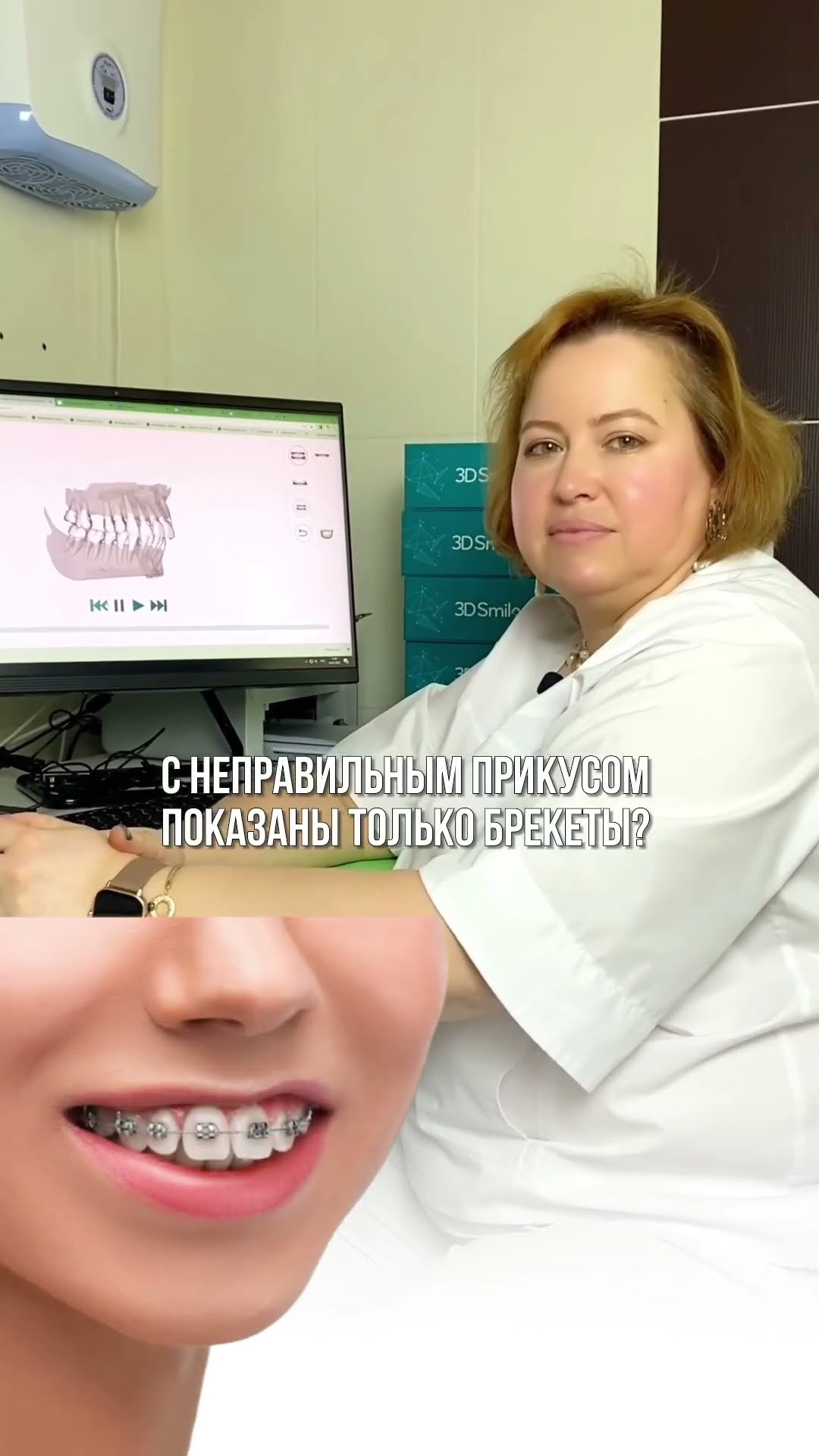 превью для видео: Неправильный прикус лечится только брекетами?