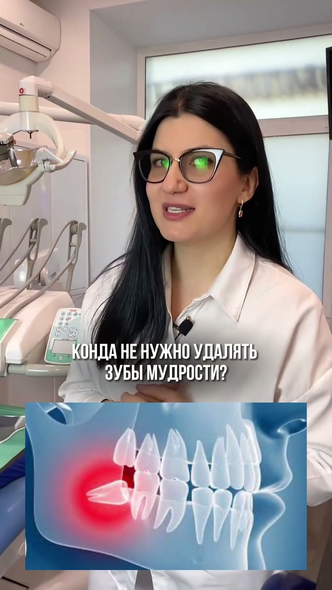 превью для видео: Когда можно не удалять зубы мудрости?