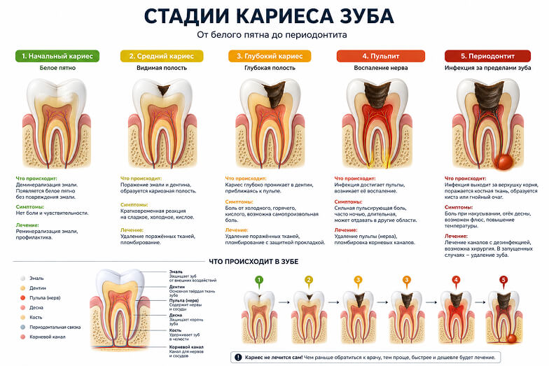 стадии кариеса